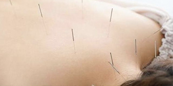 Acupuncture Services at PS Physio Clinic in Longmont CO