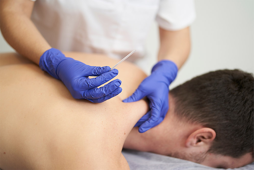 Dry Needling and Acupuncture Services Available