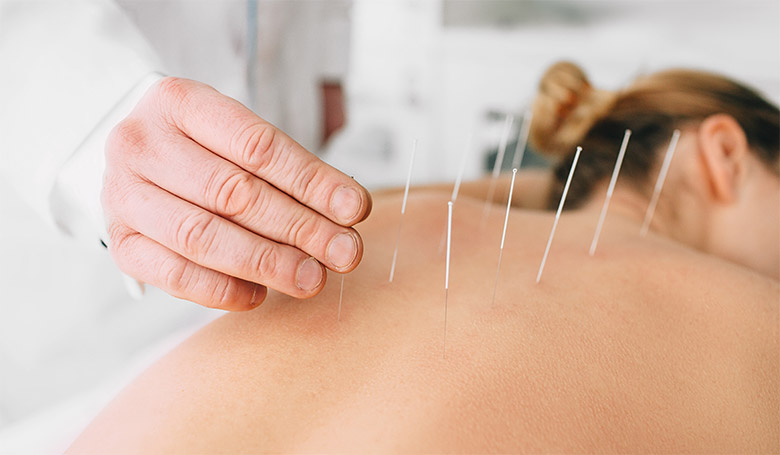 Woman receiving acupuncture service at PSPhysio Clinic in Longmont