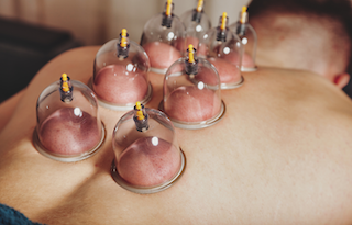 Cupping Therapy at Performance SportsPhysio Clinic in Longmont